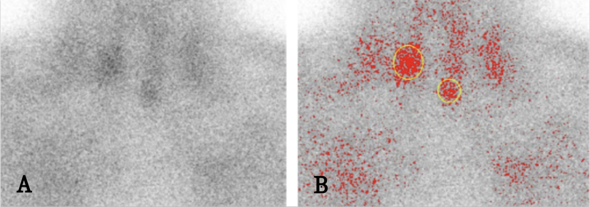 Figure 1 — Positive finding: delayed phase scan with two adenomas marked